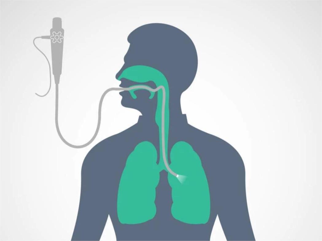 電子支氣管鏡在醫(yī)療實踐中的應(yīng)用